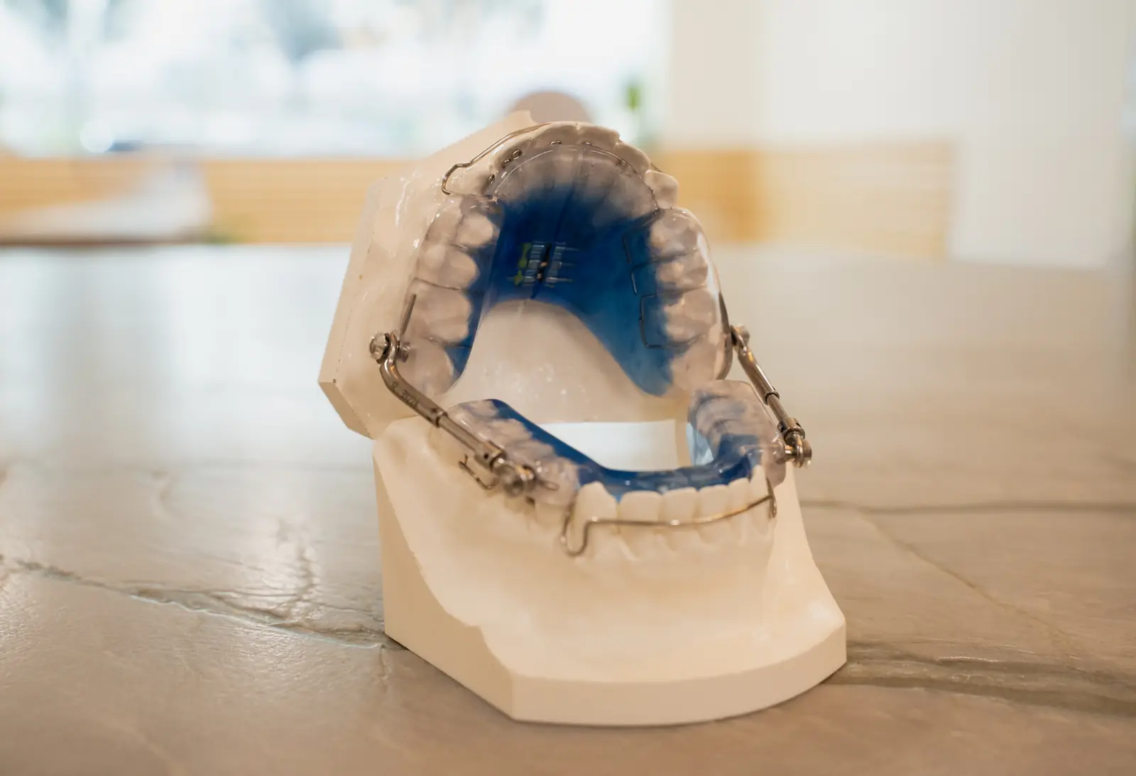 Custom removable upper and lower oral appliance on an articulated model, similar to the appliances used in Vivos treatment in Draper, Utah