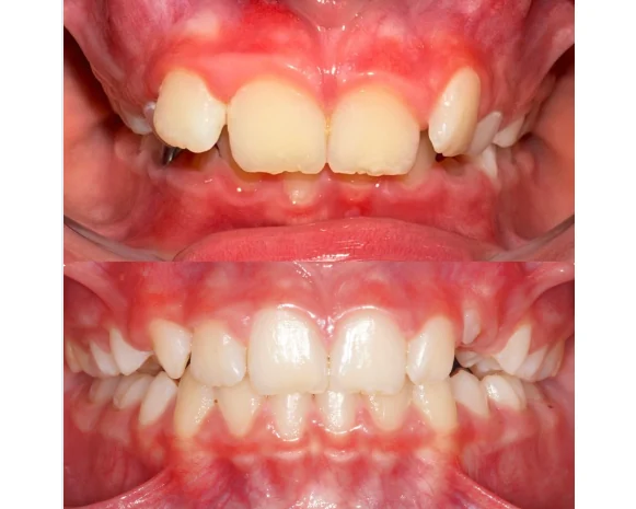 A child's upper front teeth before palate expansion and after, with more room for the front teeth, from Dr. Jeff Buxton's office in Draper, Utah
