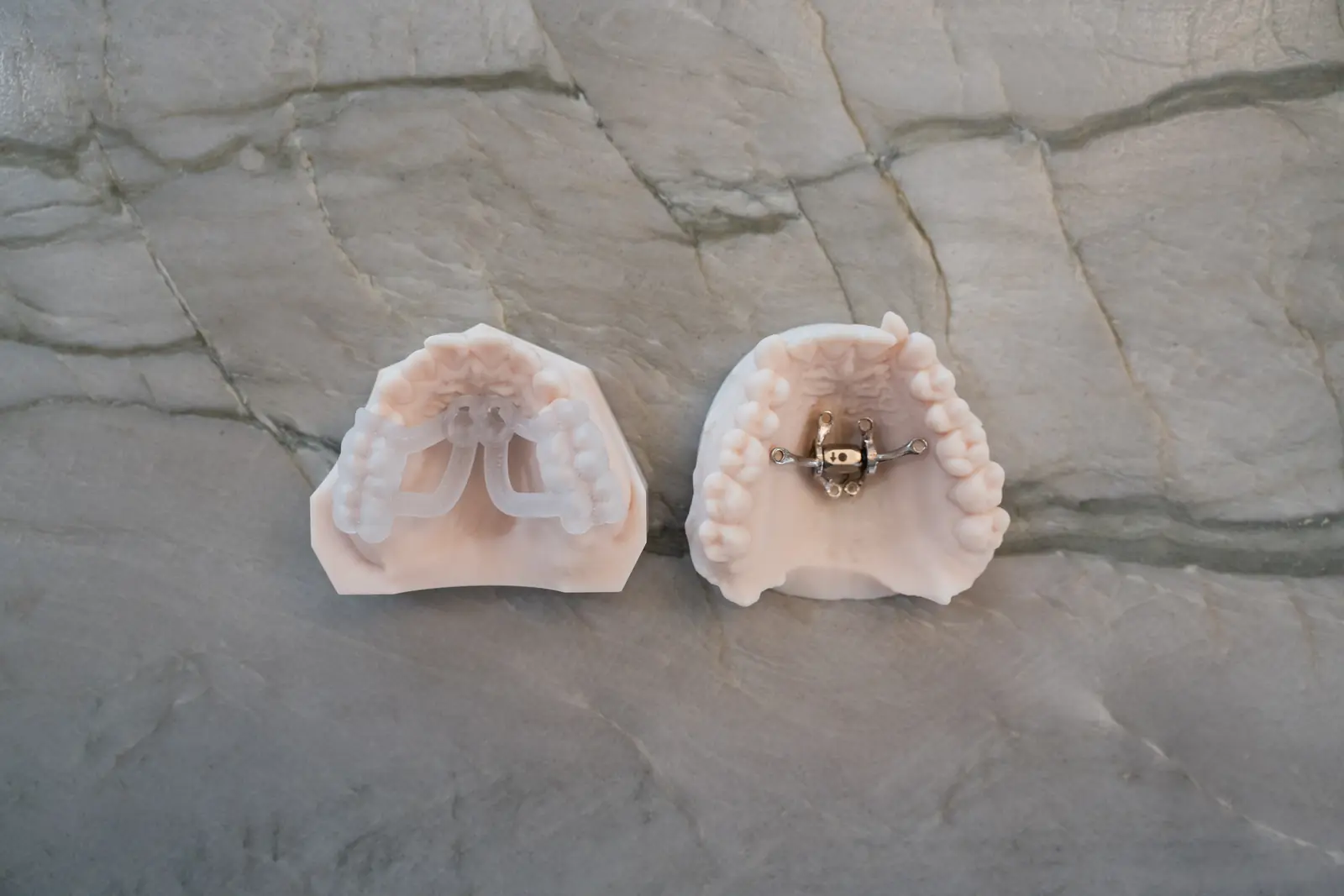 A fixed expander and a clear appliance on two dental models used to explain how MARPE palate expansion works, Draper, Utah