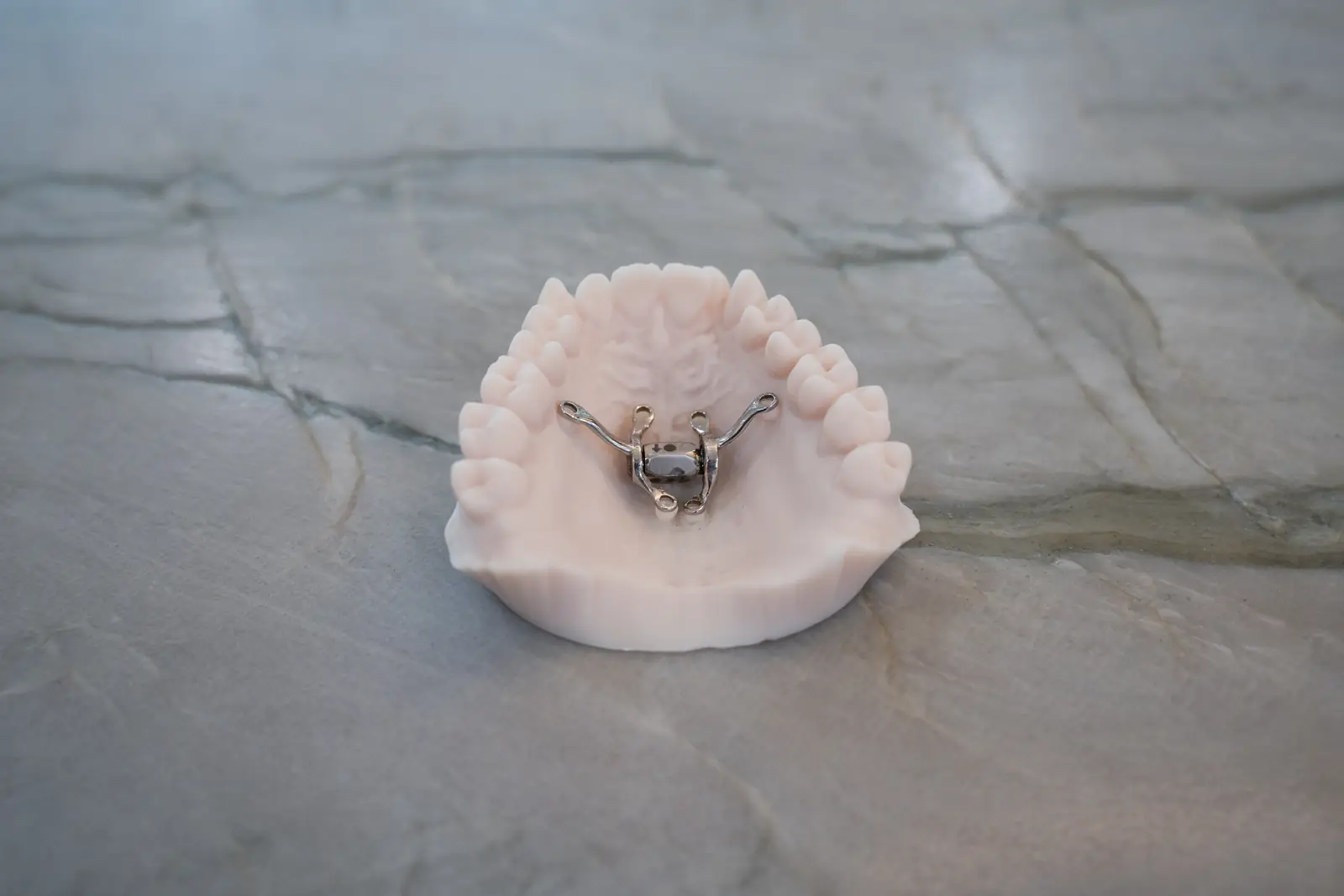Fixed palatal expander on a dental model used to explain adult palate expansion options at Toothpillow Breathing & Sleep Center in Draper, Utah