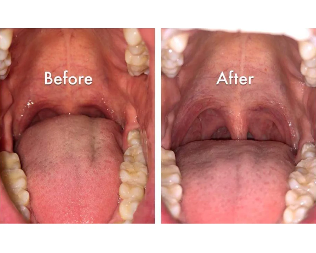 Before and after QuietNite laser treatment of the soft palate at Toothpillow Breathing & Sleep Center in Draper, Utah