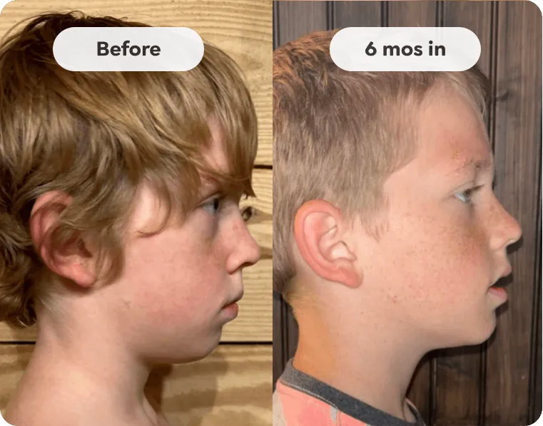 Side profile of a child before Toothpillow care and six months in