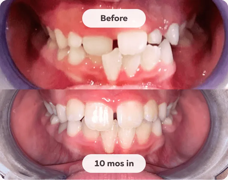 A child's teeth before early growth guidance and ten months in, showing a more open, better aligned smile